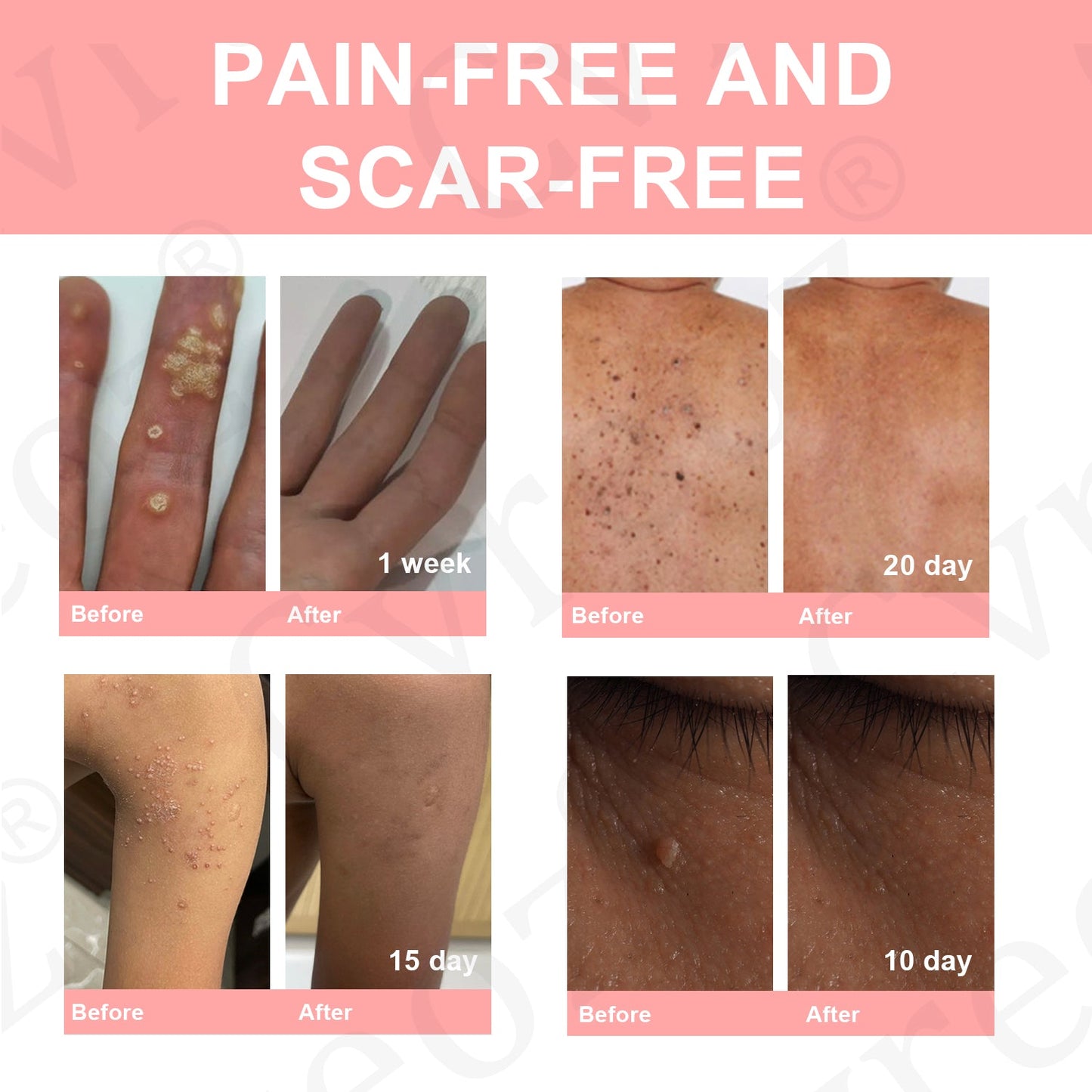 Cvreoz® Dual Acid Wart & Mole Removal Serum