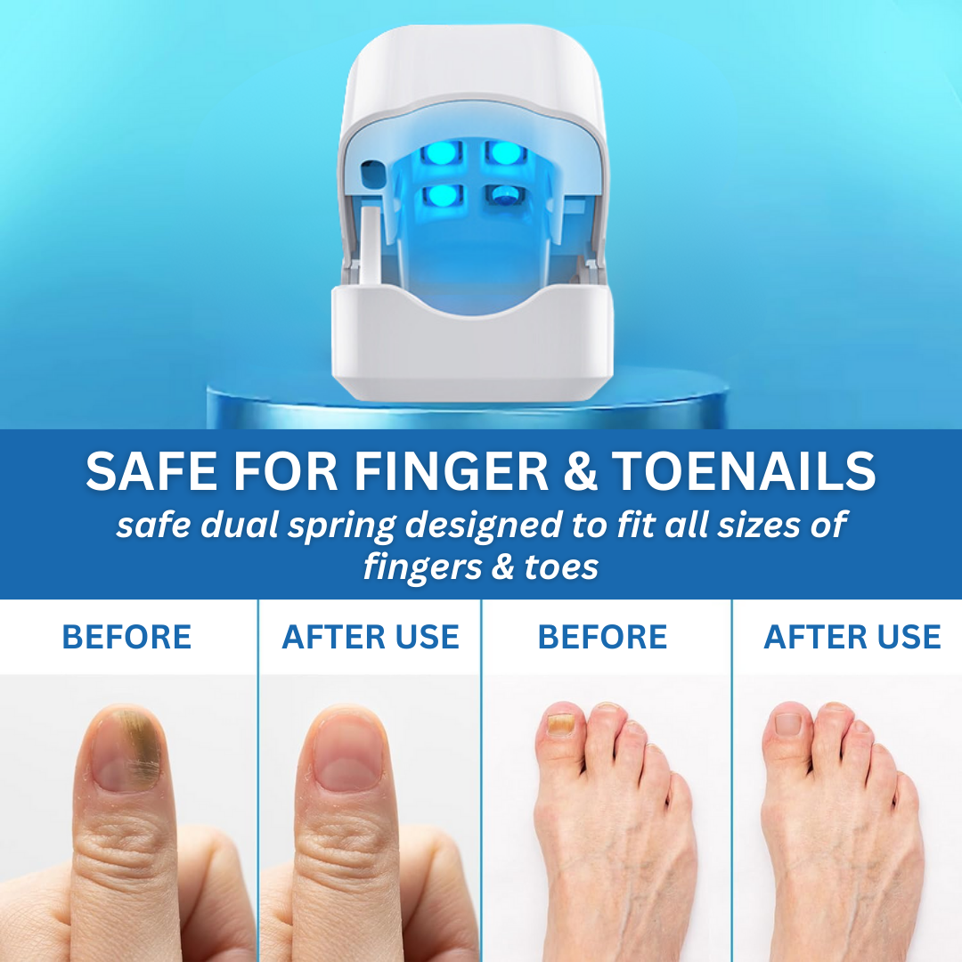 Bikenda® Nail Fungus ✅ 𝕤𝕒𝕧𝕖 𝕦𝕡 𝕥𝕠 8𝟘% Laser Treatment Device
