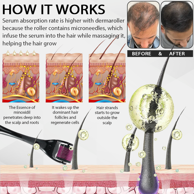 FolliFusion™ Max Absorb  MinoxidilSerum Dermaroller Kit