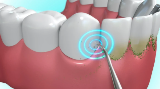 Sonic Pic Dental Cleaning System